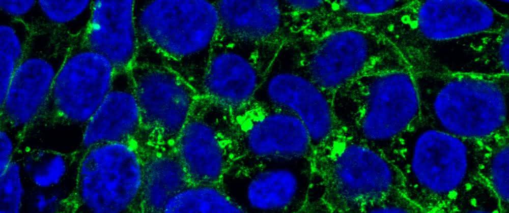 In den induzierten pluripotenten Stammzellen einer Patientin befindet sich das Glut1-Protein vor allem im Zellinneren (grün markiert).