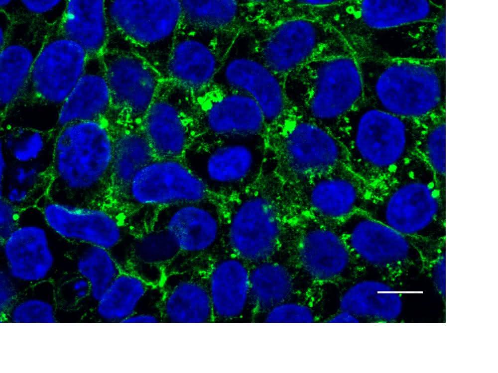 In den induzierten pluripotenten Stammzellen einer Patientin befindet sich das Glut1-Protein vor allem im Zellinneren (grün markiert). In den induzierten pluripotenten Stammzellen einer Patientin befindet sich das Glut1-Protein vor allem im Zellinneren (grün markiert).