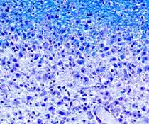 Schwindende Nervenhüllen: An den lädierten Stellen (unten im Bild) im Gehirn von MS-Patienten fehlt das Myelin (oben in blau).Schwindende Nervenhüllen: An den lädierten Stellen (unten im Bild) im Gehirn von MS-Patienten fehlt das Myelin (oben in blau). Gewebeschnitt mit Anfärbung des Myelins