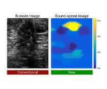 Das neue Ultraschallverfahren zeigt einen Brustkrebstumor ganz deutlich in Gelb (Bild rechts). Links das schwerer zu deutende herkömmliche Ultraschallbild. Ultraschallbilder alters und neues Verfahren im Vergleich
