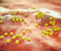 MRSA-Bakterien (Staphylococcus aureus) machen sich mit Hilfe eines Proteins unsichtbar für das Immunsystem. MRSA-Bakterien (Staphylococcus aureus) machen sich mit Hilfe eines Proteins unsichtbar für das Immunsystem.