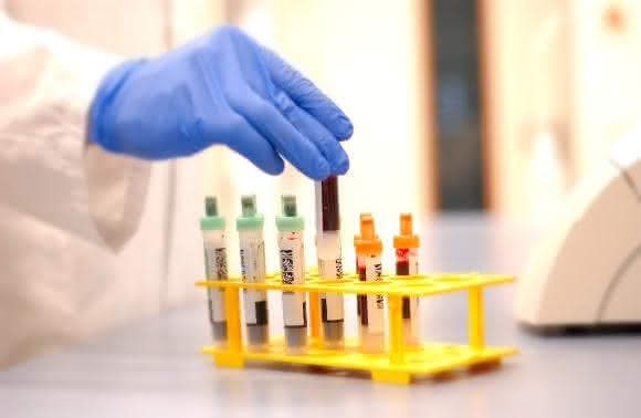 Ein Bluttest für die schnelle Diagnose der Alzheimerischen Erkrankung Ein Bluttest für die schnelle Diagnose der Alzheimerischen Erkrankung