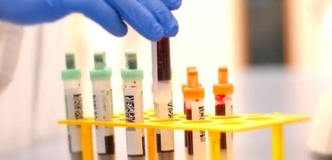 Ein Bluttest für die schnelle Diagnose der Alzheimerischen Erkrankung