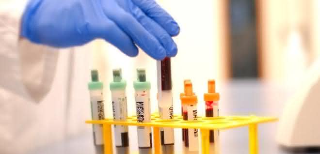 Ein Bluttest für die schnelle Diagnose der Alzheimerischen Erkrankung Ein Bluttest für die schnelle Diagnose der Alzheimerischen Erkrankung