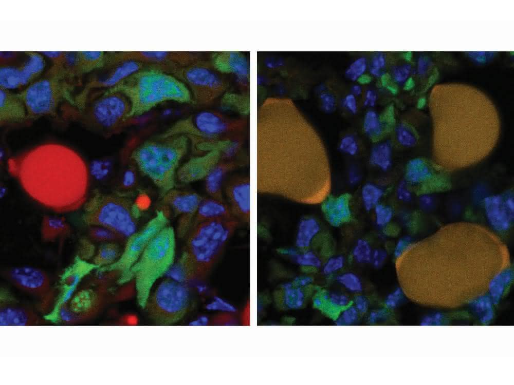 Krebszellen (grün) und eine rot markierte Fettzelle an der Oberfläche eines Tumors (links). Nach der Therapie (rechts) haben sich drei Krebszellen in Fettzellen (dunkelgelb) umgewandelt.