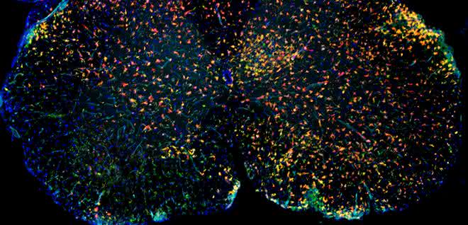 Immunfluoreszenz von entzündlich verändertem Rückenmark mit roten Mikrogliazellen und grünen aus dem Blut eingewanderten Makrophagen. Immunfluoreszenz von entzündlich verändertem Rückenmark mit roten Mikrogliazellen und grünen aus dem Blut eingewanderten Makrophagen.