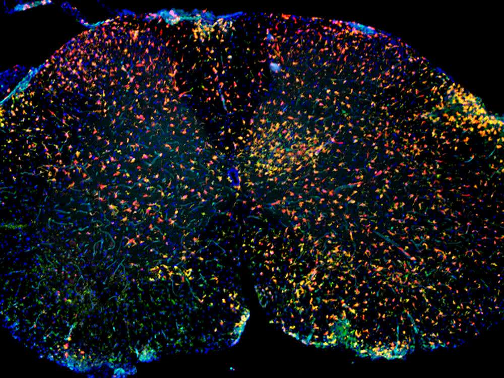 Immunfluoreszenz von entzündlich verändertem Rückenmark mit roten Mikrogliazellen und grünen aus dem Blut eingewanderten Makrophagen. Immunfluoreszenz von entzündlich verändertem Rückenmark mit roten Mikrogliazellen und grünen aus dem Blut eingewanderten Makrophagen.