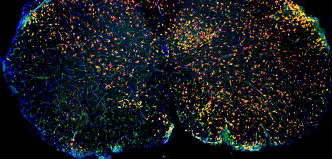 Immunfluoreszenz von entzündlich verändertem Rückenmark mit roten Mikrogliazellen und grünen aus dem Blut eingewanderten Makrophagen. Immunfluoreszenz von entzündlich verändertem Rückenmark mit roten Mikrogliazellen und grünen aus dem Blut eingewanderten Makrophagen.