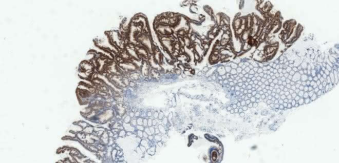 Mikroskopische Aufnahme von entarteten menschlichen Darmpolypen mit immunohistochemischer Anfärbung des Biomarkers DIA2 zur Erkennung früher Darmkrebsstadien (Adenoma) und das angrenzende gesunde Gewebe. Mikroskopische Aufnahme von entarteten menschlichen Darmpolypen