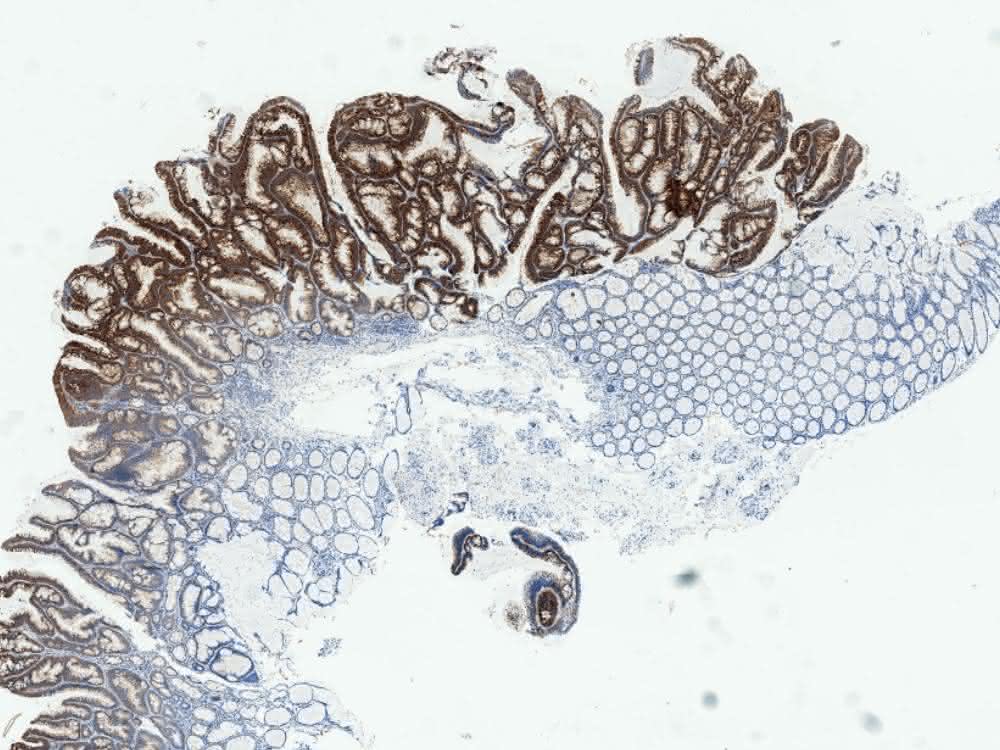 Mikroskopische Aufnahme von entarteten menschlichen Darmpolypen