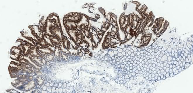 Mikroskopische Aufnahme von entarteten menschlichen Darmpolypen