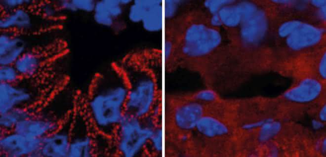 In gesunden Mäusen wird das rot markierte Protein (Desmoplakin) von den Darmzellen in Desmosomen eingebaut (links). Ein fehlerhafter Insulinsignalweg führt zum Verbleib des Proteins im Zellplasma (rechts). In gesunden Mäusen wird das Protein Desmoplakin von den Darmzellen in Desmosomen eingebaut. Ein fehlerhafter Insulinsignalweg führt zum Verbleib des Proteins im Zellplasma.