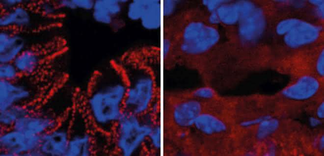 In gesunden Mäusen wird das rot markierte Protein (Desmoplakin) von den Darmzellen in Desmosomen eingebaut (links). Ein fehlerhafter Insulinsignalweg führt zum Verbleib des Proteins im Zellplasma (rechts). In gesunden Mäusen wird das Protein Desmoplakin von den Darmzellen in Desmosomen eingebaut. Ein fehlerhafter Insulinsignalweg führt zum Verbleib des Proteins im Zellplasma.