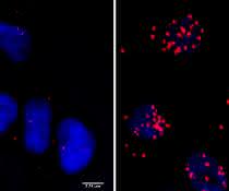 Zellen eines Neuroblastoms ... Zellen eines Neuroblastoms