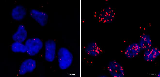 Zellen eines Neuroblastoms ... Zellen eines Neuroblastoms