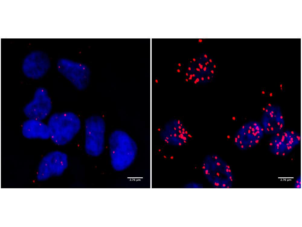 Zellen eines Neuroblastoms ... Zellen eines Neuroblastoms