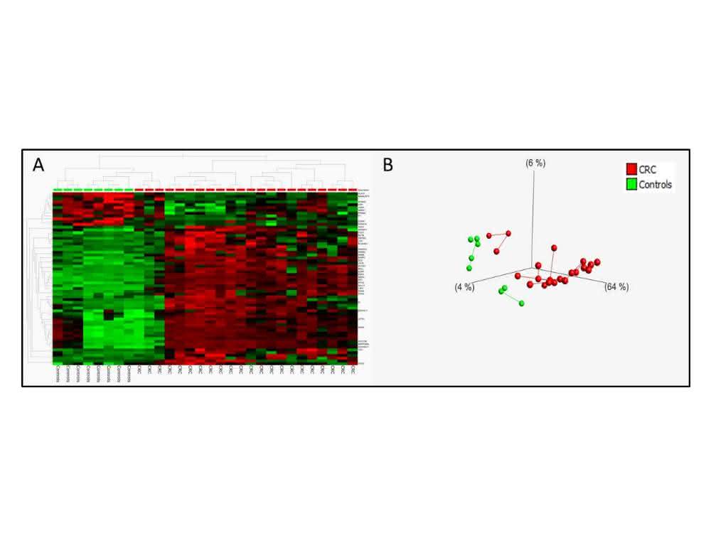 Bild 3: A: Heatmap zur Darstellung unterschiedlich methylierter CpGs basierend auf Infinium-Array-Methylierungsanalysen von Tumor-DNA ... Bild 3: A: Heatmap zur Darstellung unterschiedlich methylierter CpGs basierend auf Infinium-Array-Methylierungsanalysen von Tumor-DNA ...