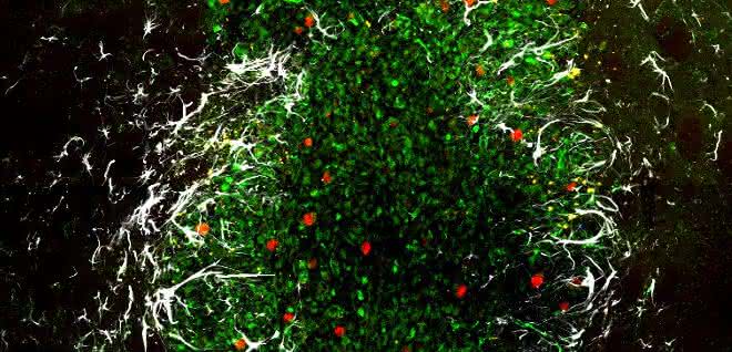 Glioblastom im Gehirn einer Maus: Grün dargestellt sind die Tumorzellen, rote Farbe zeigt Zellteilungen an, die Astrozyten erscheinen weiß. Glioblastom im Gehirn einer Maus: Grün dargestellt sind die Tumorzellen, rote Farbe zeigt Zellteilungen an, die Astrozyten erscheinen weiß.