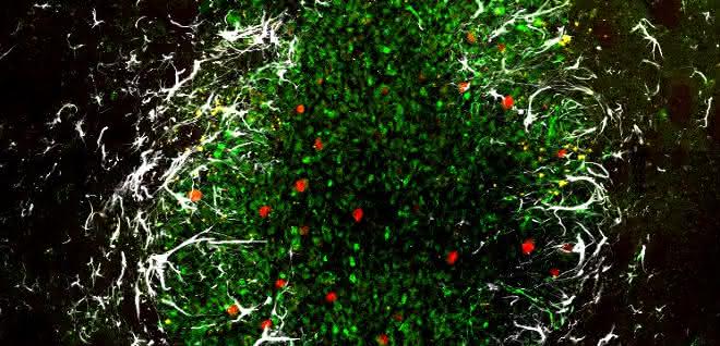 Glioblastom im Gehirn einer Maus: Grün dargestellt sind die Tumorzellen, rote Farbe zeigt Zellteilungen an, die Astrozyten erscheinen weiß.