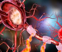 Morbus Parkinson: Studie bringt oxidativen Stress mit der Ausbreitung anormaler Proteine in Verbindung Künstlerische Darstellung eines Neurons