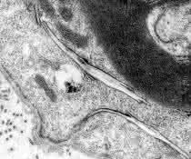 Elektronenmikroskopische Aufnahme:  Cholesterin sammelt sich bei einer Störung des Abbaumechanismus in länglichen, kristallartigen Strukturen im Nervengewebe an.
