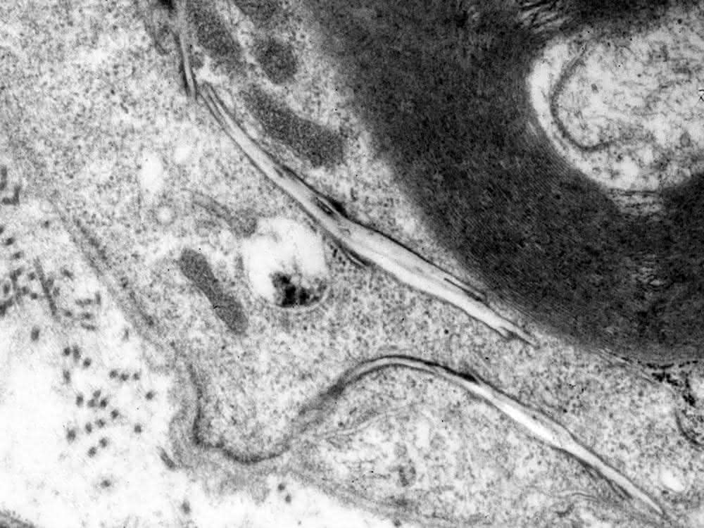 Elektronenmikroskopische Aufnahme:  Cholesterin sammelt sich bei einer Störung des Abbaumechanismus in länglichen, kristallartigen Strukturen im Nervengewebe an.