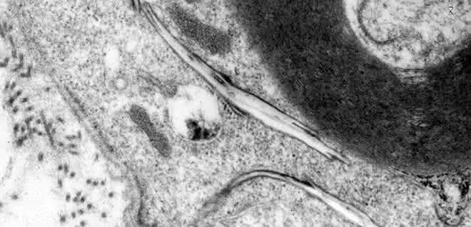 Elektronenmikroskopische Aufnahme:  Cholesterin sammelt sich bei einer Störung des Abbaumechanismus in länglichen, kristallartigen Strukturen im Nervengewebe an.