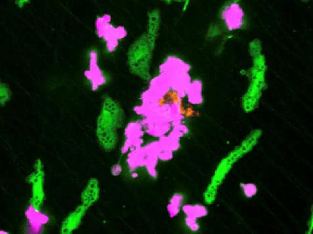 „Verstopfte“ Makrophagen (in grün) verlieren die Fähigkeit, auf Gewebsschäden (in orange) zu reagieren, diese abzuschirmen und das Gewebe zu schützen, was zu einer Aktivierung neutrophiler Granulozyten (in magenta) und schließlich zu einer ungewollten Entzündung führt. Mikroskopische Aufnahme.