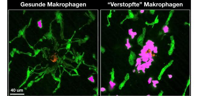 „Verstopfte“ Makrophagen (in grün) verlieren die Fähigkeit, auf Gewebsschäden (in orange) zu reagieren, diese abzuschirmen und das Gewebe zu schützen, was zu einer Aktivierung neutrophiler Granulozyten (in magenta) und schließlich zu einer ungewollten Entzündung führt. Mikroskopische Aufnahme.