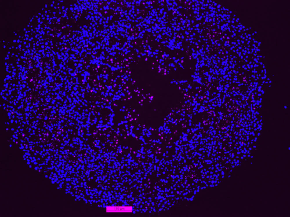 Im Inneren des Spheroids sterben Zellen am programmierten Zelltod Apoptose (pink) Im Inneren des Spheroids sterben Zellen am programmierten Zelltod Apoptose (pink)