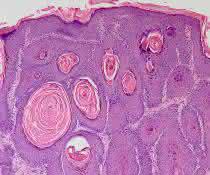 Histologische Färbung eines HPV8-E7 induzierten Maushaut-Tumors. Vergrößerung 100x Histologische Färbung eines HPV8-E7 induzierten Maushaut-Tumors. Vergrößerung 100x