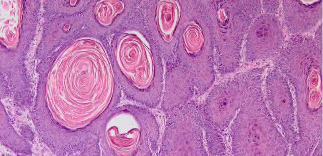 Histologische Färbung eines HPV8-E7 induzierten Maushaut-Tumors. Vergrößerung 100x Histologische Färbung eines HPV8-E7 induzierten Maushaut-Tumors. Vergrößerung 100x