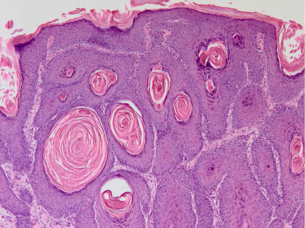 Histologische Färbung eines HPV8-E7 induzierten Maushaut-Tumors. Vergrößerung 100x Histologische Färbung eines HPV8-E7 induzierten Maushaut-Tumors. Vergrößerung 100x