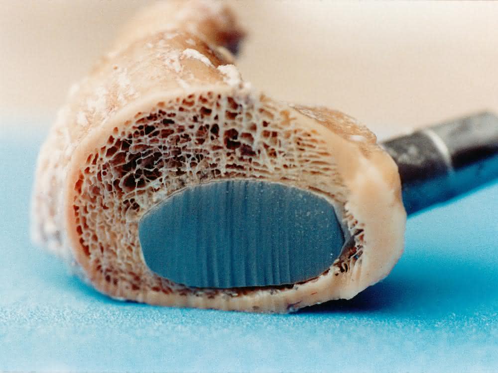 Waterjet cutting through the implant and bone Separating incision through implant and bone