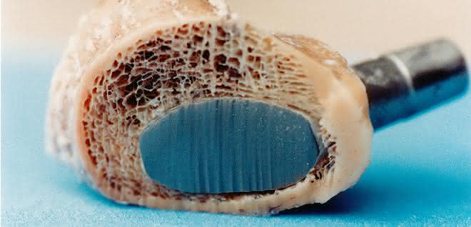 Separating incision through implant and bone