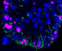 Menschliche ccRCC-Organoide unter dem Mikroskop, markiert mit fluoreszenten Farbstoffen. Menschliche ccRCC-Organoide unter dem Mikroskop, markiert mit fluoreszenten Farbstoffen