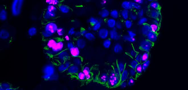 Menschliche ccRCC-Organoide unter dem Mikroskop, markiert mit fluoreszenten Farbstoffen