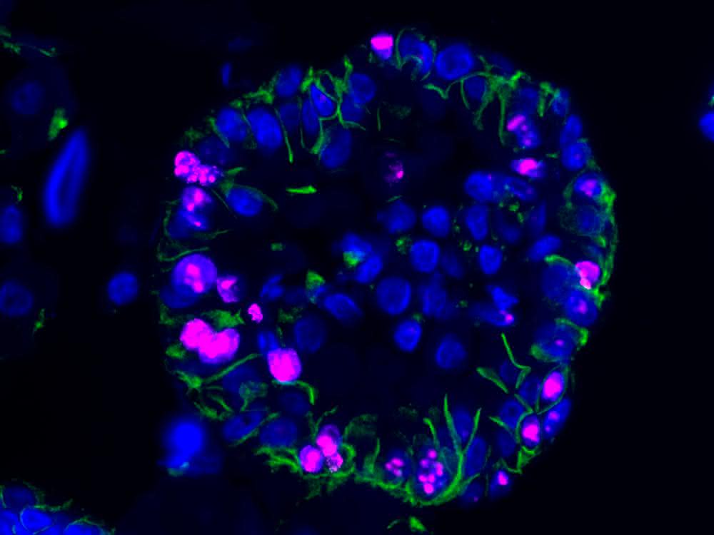 Menschliche ccRCC-Organoide unter dem Mikroskop, markiert mit fluoreszenten Farbstoffen. Menschliche ccRCC-Organoide unter dem Mikroskop, markiert mit fluoreszenten Farbstoffen
