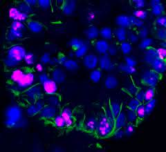 Menschliche ccRCC-Organoide unter dem Mikroskop, markiert mit fluoreszenten Farbstoffen