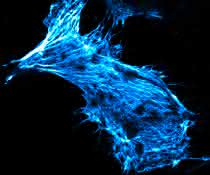 Krebszelle in Zellkultur, deren Skelett mit fluoreszierendem Phalloidin gefärbt ist. Krebszelle in Zellkultur, deren Skelett mit fluoreszierendem Phalloidin gefärbt ist.