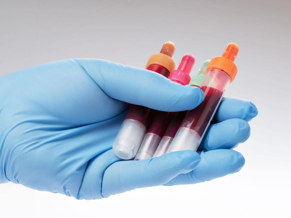 Fehlgefaltetes Alpha-Synuclein aus Nervenzellen als Indikator zur Früherkennung: Bluttest für Parkinson in Aussicht Behandschuhte Hand hält Röhrchen mit Blutproben
