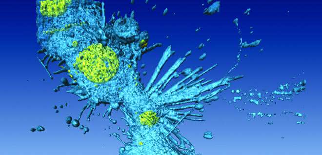 Bluttest zwecks Risikoeinschätzung: Mikro-RNAs als Biomarker Lungenkrebszellen